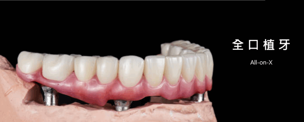 全口植牙