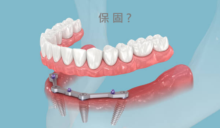 植牙保固