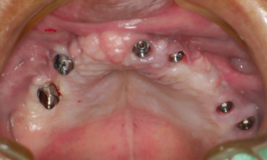 全口植牙