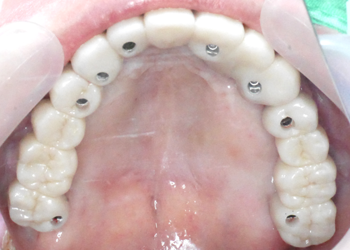 全口植牙